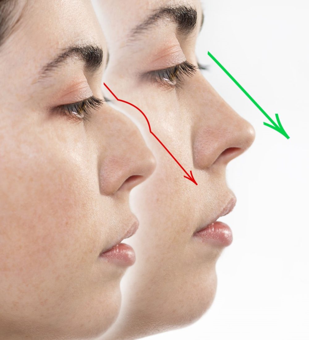 Rhinoplasty. Two female faces close-up showing the result before and after rhinoplasty. Side view. White background. Copy space.