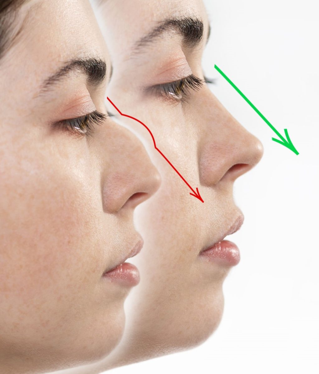 dl.beatsnoop.com-16581698705hWR Rhinoplasty. Two female faces close-up showing the result before and after rhinoplasty. Side view. White background. Copy space.